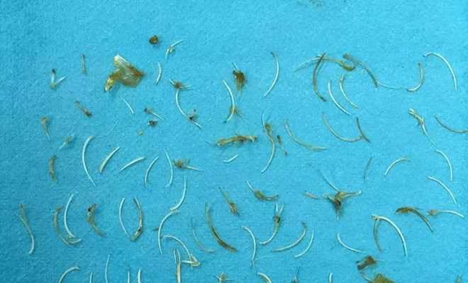 Người đàn ông bị tới 100 mảnh xương cá mắc kẹt trong ruột