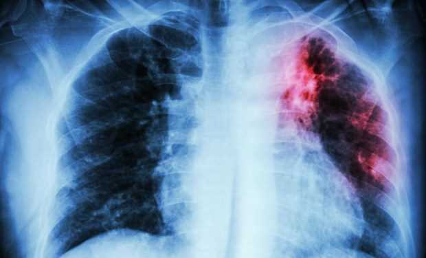 Xác định loại gene mở ra hy vọng cho bệnh nhân ung thư phổi