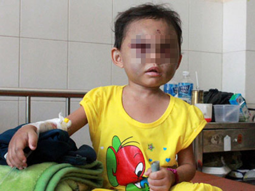 Bé 4 tuổi cấp cứu nghi bị mẹ và cha dượng hành hạ