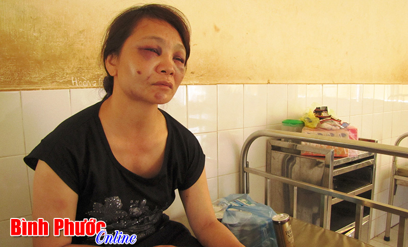 Bị chồng đánh phải nhập viện Bị chồng đánh phải nhập viện