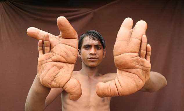 Cậu bé bị dân làng gọi là "quỷ dữ" vì đôi tay to bất thường