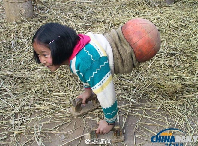 Nghị lực tuyệt vời của "cô bé bóng rổ" phải cắt bỏ đôi chân Nghị lực tuyệt vời của "cô bé bóng rổ" phải cắt bỏ đôi chân