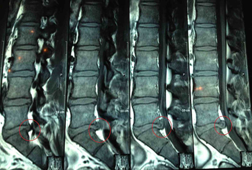 disc-herniation04092014103948.jpg