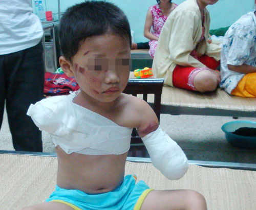 Bé trai 5 tuổi bị gấu cắn đứt 2 tay Bé trai 5 tuổi bị gấu cắn đứt 2 tay