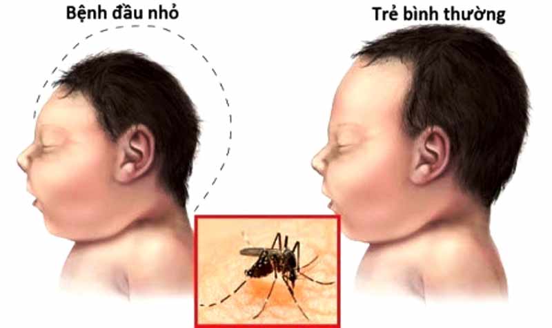images676204_Zika.jpg