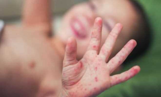 Mỹ ban bố tình trạng khẩn cấp tại bang miền Tây do bệnh sởi