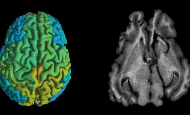 Kỹ thuật MRI mới giúp sớm phát hiện các căn bệnh thoái hóa thần kinh Kỹ thuật MRI mới giúp sớm phát hiện các căn bệnh thoái hóa thần kinh