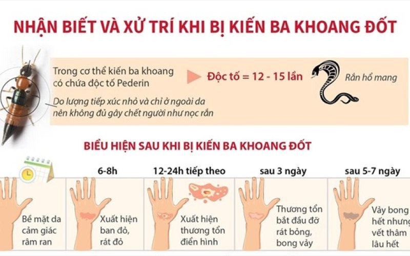 Nhận biết và xử trí khi bị kiến ba khoang đốt