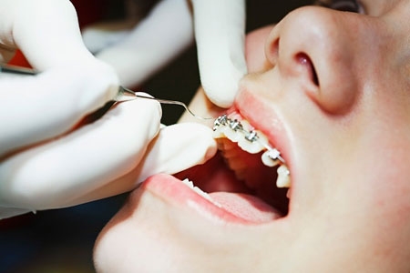 Những tai nạn kỳ quặc, tế nhị của niềng răng
