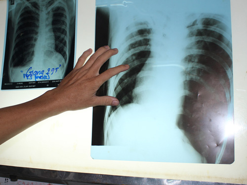 phoi-trai.jpg