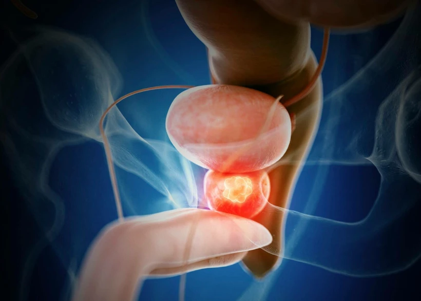 prostate-cancer-ung-thu-tien-liet-tuyen.jpg.webp
