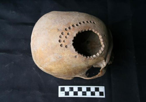 Phẫu thuật mở sọ hơn 1.000 năm trước Phẫu thuật mở sọ hơn 1.000 năm trước