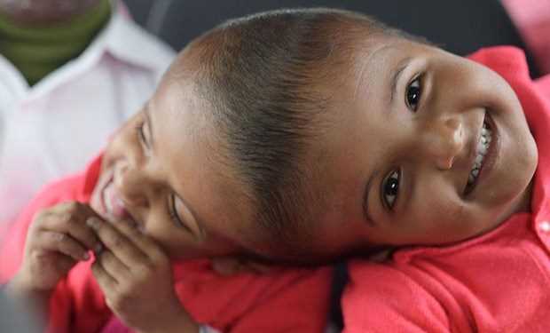 Tách thành công cặp song sinh dính nhau phần đầu ở Bangladesh