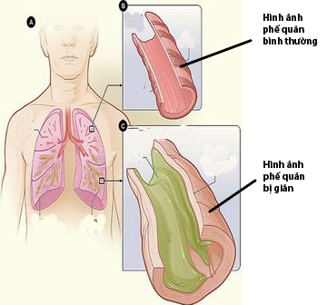 Phòng bệnh giãn phế quản Phòng bệnh giãn phế quản