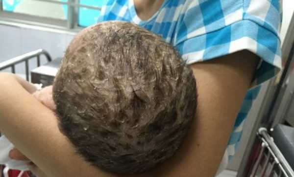 Bé trai nhiễm độc da toàn thân do mẹ tắm lá chữa thủy đậu Bé trai nhiễm độc da toàn thân do mẹ tắm lá chữa thủy đậu
