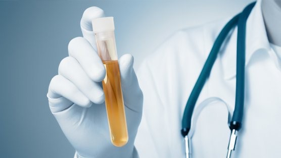 Tự 'bắt bệnh' cơ thể bằng quan sát nước tiểu hàng ngày