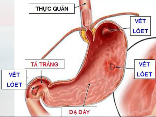 Viêm loét dạ dày dễ dẫn đến ung thư