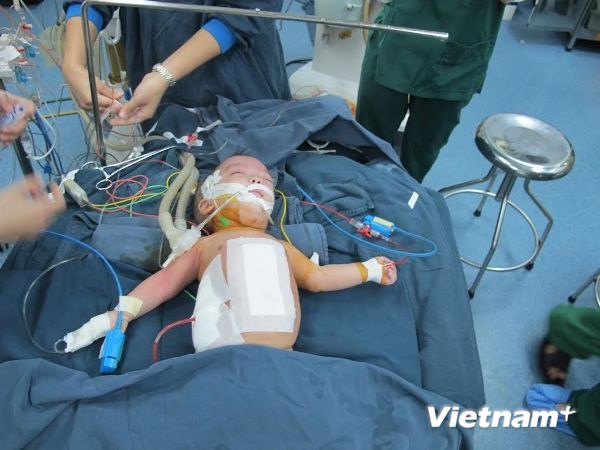 Phẫu thuật tách thành công hai trẻ 4 tháng tuổi dính liền bụng