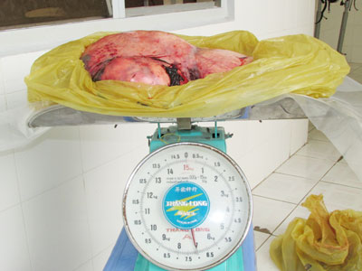 Sóc Trăng: Lấy khối u nặng 7 kg ra khỏi cụ bà 78 tuổi Sóc Trăng: Lấy khối u nặng 7 kg ra khỏi cụ bà 78 tuổi